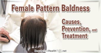 Female Pattern Baldness